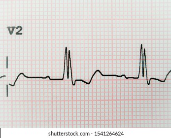 Electrocardiogram (RBBB) Is A Heart Block In The Right Bundle Branch Of The Electrical Conduction System.