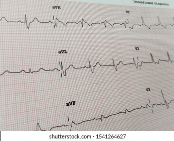 Electrocardiogram (RBBB) Is A Heart Block In The Right Bundle Branch Of The Electrical Conduction System.