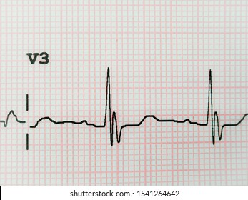 Electrocardiogram (RBBB) Is A Heart Block In The Right Bundle Branch Of The Electrical Conduction System.