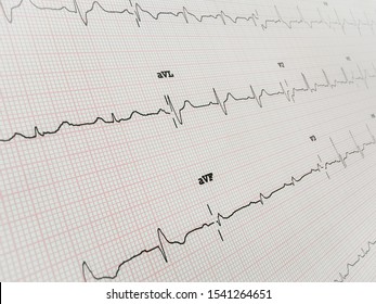 Electrocardiogram (RBBB) Is A Heart Block In The Right Bundle Branch Of The Electrical Conduction System.