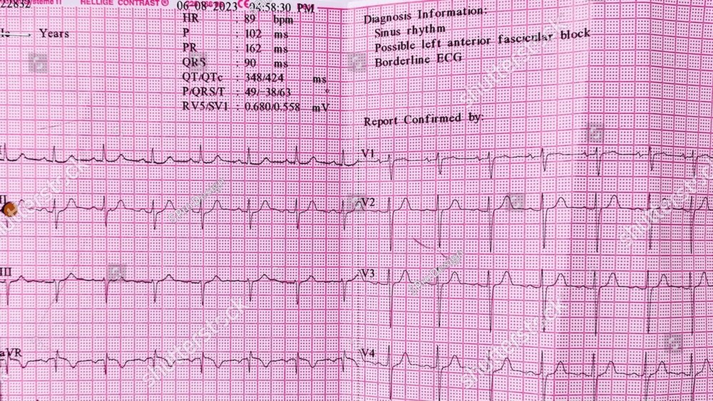 Electrocardiogram show Sinus bradycardia pattern. Cardiac fibrillation ...