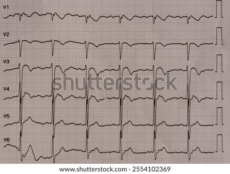 An Electrocardiogram showing multiple leads with inverted T waveforms in V1- to V4 indicating myocardial ischemia from coronary stenosis.