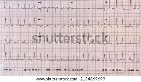 The electrocardiogram that shows atrial fibrillation in a man who present at emergency room with problem of palpitation.   
