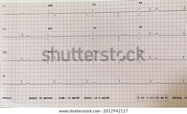 Electrocardiogram That Shows Sinus Bradycardia Young Stock Photo ...