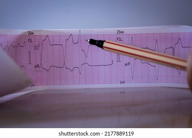 Electrocardiogram With A Ventricular Extrasystole. Cardiac Arrhythmia. Pen Pointing To Cardiovascular Alteration.