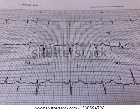 Electrocardiogram of wave in paper report analysis. Medical and healthcare concept.
