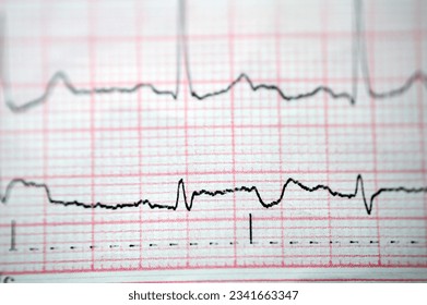 An ElectroCardioGraph ECG, a chart that draws the electricity of the heart and gives an idea on the heart condition and the rhythm and excludes any angina pectoris or myocardial infarction, Normal ECG