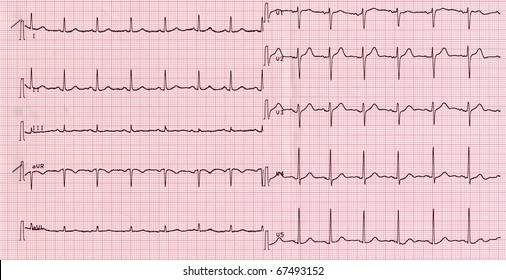 Electrocardiography Aka Ekg Elektrokardiogramm Measure Heartbeat Stock ...