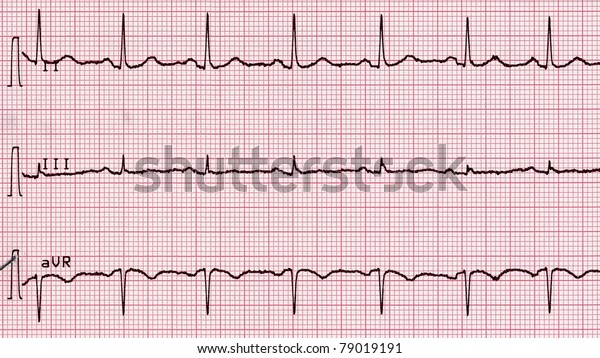 Electrocardiography Aka Ekg Elektrokardiogramm Measure Heartbeat Stock 