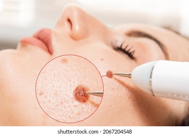 Electrocoagulation and laser cosmelotogy. Dermatologist using a professional electrocautery for removing mole. Zoomed area of melanoma.