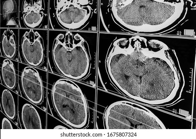 Electromagnetic Tomography Brain. Sequence of vertical sections of a human brain - MRI scan. Real brain MRI slide of a girl. Minimal editing to save fine details. Traumatic brain injury. Medical - Shutterstock ID 1675807324