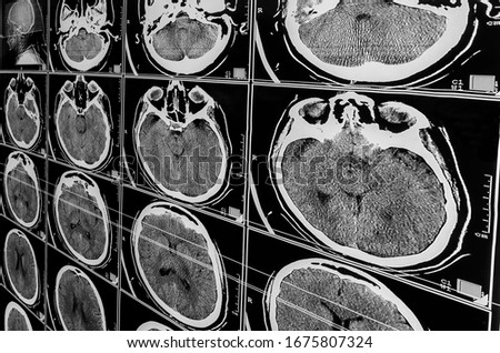Electromagnetic Tomography Brain. Sequence of vertical sections of a human brain - MRI scan. Real brain MRI slide of a girl. Minimal editing to save fine details. Traumatic brain injury. Medical