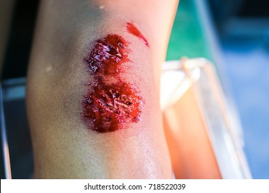 Emergency Accident Open Abrasion Wound Trauma Skin .Patient Accident Wound Blood Injury And First Aid Dressing Care Healing.selective Focus
