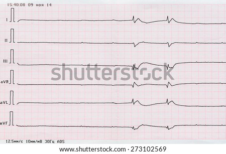Emergency Cardiology. ECG tape with single ventricular complexes and ventricular asystole (