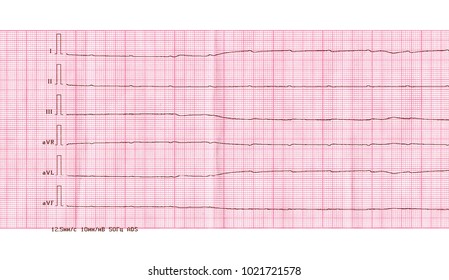 Asystole meaning