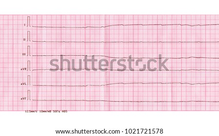 Emergency cardiology and resuscitation. ECG tape with ventricular asystole