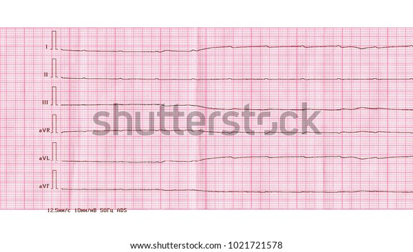 Emergency Cardiology Resuscitation Ecg Tape Ventricular Stock Photo ...