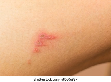 bilder av psoriasis bilder av psoriasis