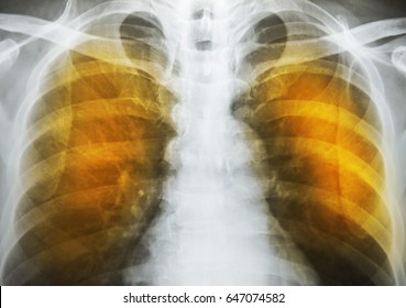 Emphysema Patient Ches X-ray.