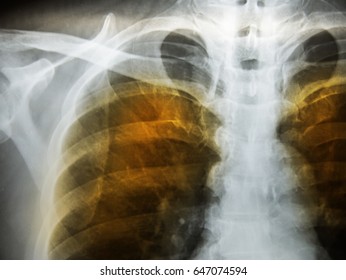 Emphysema Patient Ches X-ray.