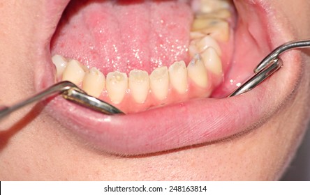 Enamel Hypoplasia Lower Front Teeth