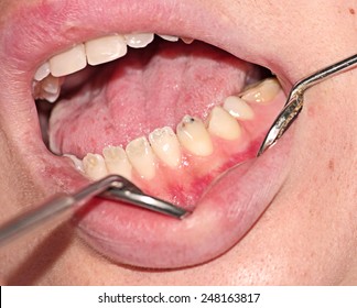 Enamel Hypoplasia Lower Front Teeth