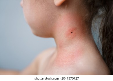 Encephalitis Mite Bug Or Arachnid Parasite Under Child Skin