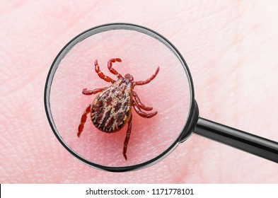 Encephalitis Virus Or Lyme Disease Infected Tick Arachnid Insect On Skin With Loupe Magnification