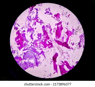 Enchondroma: Benign Bone Tumor. Microscopic Image Of Enchondroma.