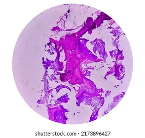 Enchondroma: Benign Bone Tumor. Microscopic Image Of Enchondroma.