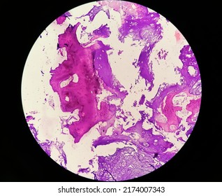 Enchondroma: Benign Bone Tumor. Microscopic Image Of Enchondroma.