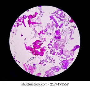 Enchondroma: Benign Bone Tumor. Microscopic Image Of Enchondroma.