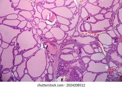 Endemic Goiter, Light Micrograph, Abnormal Enlargement Of The Thyroid Gland Due To Dietary Iodine Deficiency. Photomicrograph Shows Follicles Of Varying Size, Abundant Colloid, Lymphocytic Infiltrate