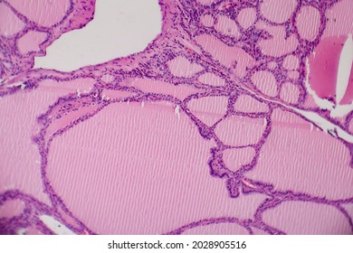 Endemic Goiter, Light Micrograph, Abnormal Enlargement Of The Thyroid Gland Due To Dietary Iodine Deficiency. Photomicrograph Shows Follicles Of Varying Size, Abundant Colloid, Lymphocytic Infiltrate