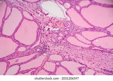 Endemic Goiter, Light Micrograph, Abnormal Enlargement Of The Thyroid Gland Due To Dietary Iodine Deficiency. Photomicrograph Shows Follicles Of Varying Size, Abundant Colloid, Lymphocytic Infiltrate