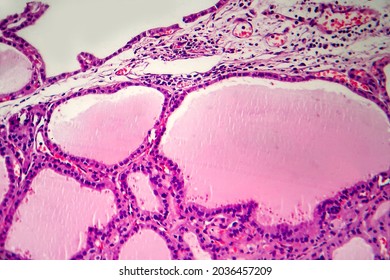 Endemic Goiter, Light Micrograph, Abnormal Enlargement Of The Thyroid Gland Due To Dietary Iodine Deficiency. Photomicrograph Shows Follicles Of Varying Size, Abundant Colloid, Lymphocytic Infiltrate