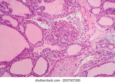 Endemic Goiter, Light Micrograph, Abnormal Enlargement Of The Thyroid Gland Due To Dietary Iodine Deficiency. Photomicrograph Shows Follicles Of Varying Size, Abundant Colloid, Lymphocytic Infiltrate