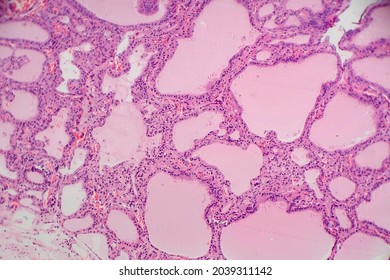 Endemic Goiter, Light Micrograph, Abnormal Enlargement Of The Thyroid Gland Due To Dietary Iodine Deficiency. Photomicrograph Shows Follicles Of Varying Size, Abundant Colloid, Lymphocytic Infiltrate