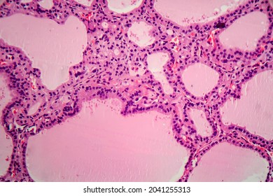 Endemic Goiter, Light Micrograph, Abnormal Enlargement Of The Thyroid Gland Due To Dietary Iodine Deficiency. Photomicrograph Shows Follicles Of Varying Size, Abundant Colloid, Lymphocytic Infiltrate