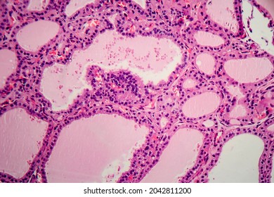 Endemic Goiter, Light Micrograph, Abnormal Enlargement Of The Thyroid Gland Due To Dietary Iodine Deficiency. Photomicrograph Shows Follicles Of Varying Size, Abundant Colloid, Lymphocytic Infiltrate