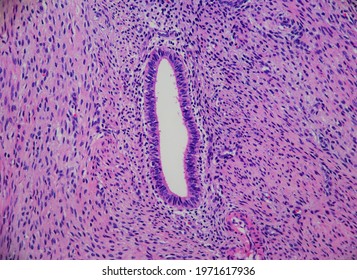 Endometrial gland and stroma surrounded by muscle in a painful condition called adenomyosis of the uterus. Actual microscopic photograph. - Shutterstock ID 1971617936