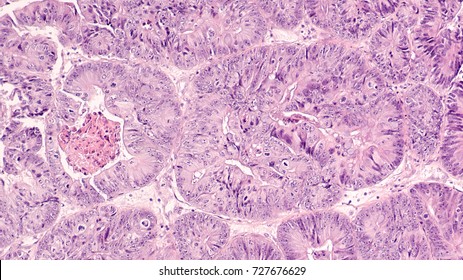 Endometrial (Uterine) Cancer Awareness: Photomicrograph Of Adenocarcinoma Of Endometrium In A Biopsy From A Patient With Abnormal Bleeding.  