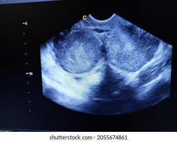 Endometrioma Ovary Cyst  By Ultrasound Scan