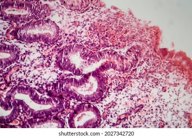 Endometriosis, A Disorder In Which Cells Similar To Those In The Endometrium Grow Outside The Uterus. Light Micrograph, Photo Under Microscope