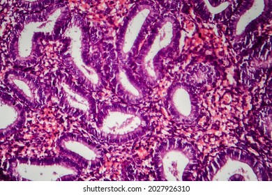 Endometriosis, A Disorder In Which Cells Similar To Those In The Endometrium Grow Outside The Uterus. Light Micrograph, Photo Under Microscope