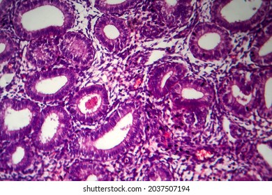 Endometriosis, A Disorder In Which Cells Similar To Those In The Endometrium Grow Outside The Uterus. Light Micrograph, Photo Under Microscope