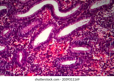 Endometriosis, A Disorder In Which Cells Similar To Those In The Endometrium Grow Outside The Uterus. Light Micrograph, Photo Under Microscope