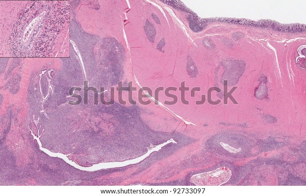 Endometriosis Image Illustrates Uterine Endometrium Infiltrating Stock ...