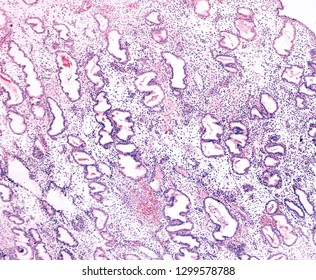 Endometrium In An Advanced Secretory Phase. The Endometrial Mucosa Shows A Secretory Phase With Very Dilated And Tortuous Glands.