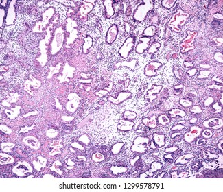 Endometrium In An Advanced Secretory Phase. The Endometrial Mucosa Shows A Secretory Phase With Very Dilated And Tortuous Glands. 